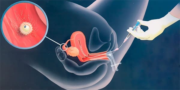 ¿En qué consiste una inseminación artificial casera?