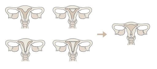 eliminación de tejido uterino