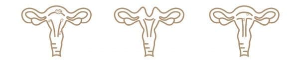 retroverted uterus