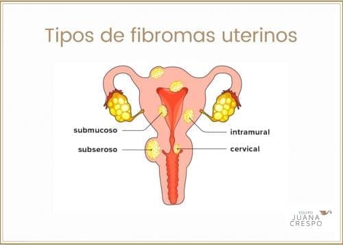 Tipos de fibromas uterinos