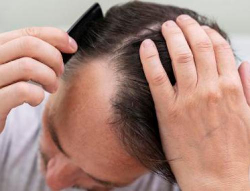 Tratamientos contra la alopecia y fertilidad, ¿qué relación hay?